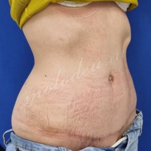 Абдомино_Колбасин