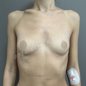 Плотникова_маммо