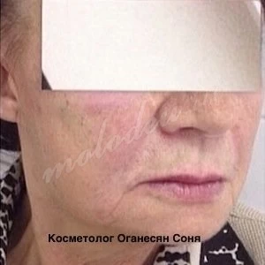 Контурная пластика лица