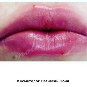 Увеличение губ