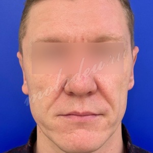 Отопластика_Гасымов