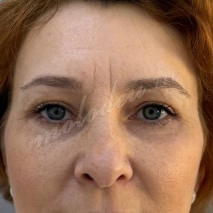 Каракаева_блефаропластика