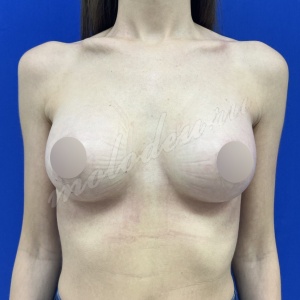 Плотникова_маммо