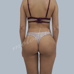 Липофилинг ягодиц_Гоглов