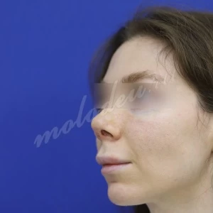 Хейлопастика Гоглов