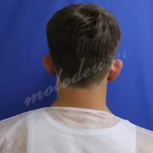 Отопластика_Мирзарахимов