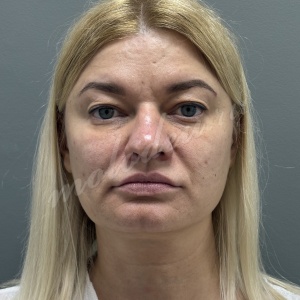 Блефаро_Делецкий