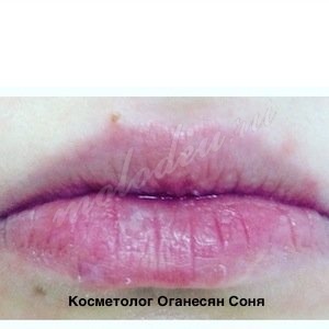 Увеличение губ