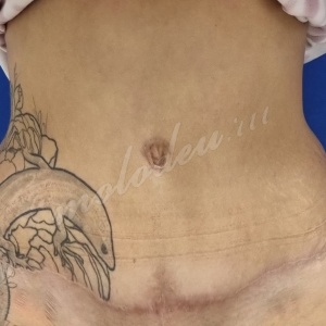 Абдомино_Колбасин