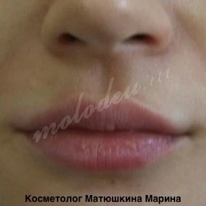 Увеличение губ. Матюшкина