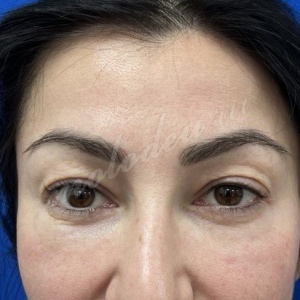 Мирзарахимов_блефаро