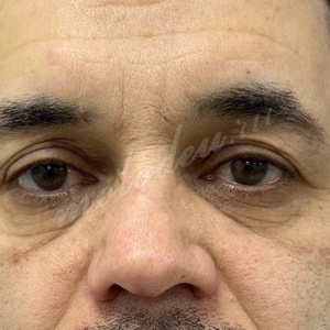 Круговая блефаро_Гасымов