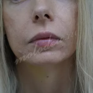 Увеличение губ