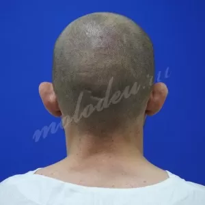 Отопластика_Агаев