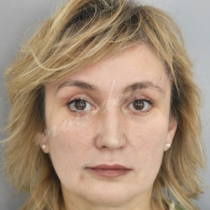 Блефаро_Гоглов