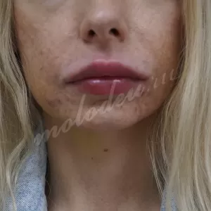 Увеличение губ