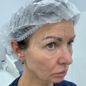 Биоармирование Радиесс