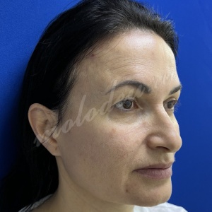 Блефаро_Мирзарахимов