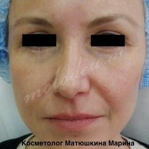 Носослезные борозды Матюшкина М.