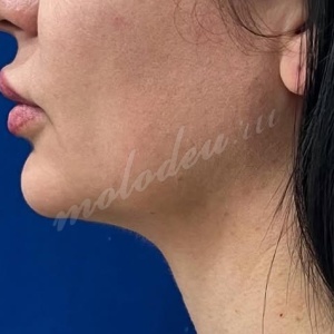 Гусев_липо_подбородок