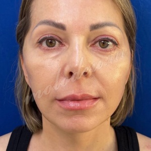 Гусев_подтяжка смас