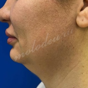 Гусев_липо_подбородок