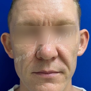 Отопластика_Гасымов