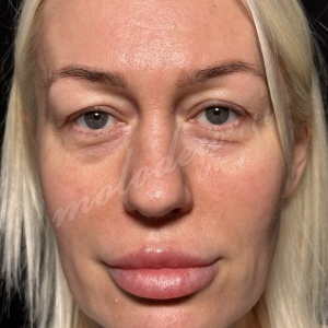 Блефаро_Овсиенко