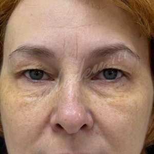 Каракаева_блефаропластика