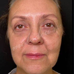 Липолиз и нитевой лифтинг_Лукина