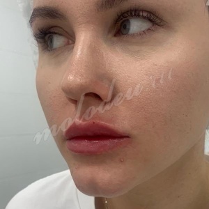 Увеличение губ