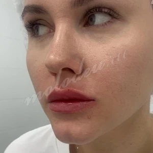 Увеличение губ