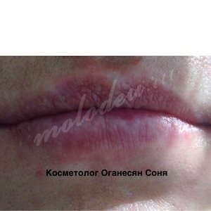 Коррекция формы губ