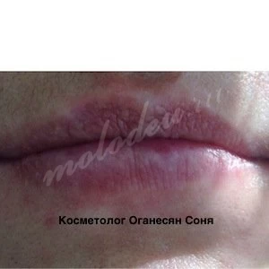 Коррекция формы губ
