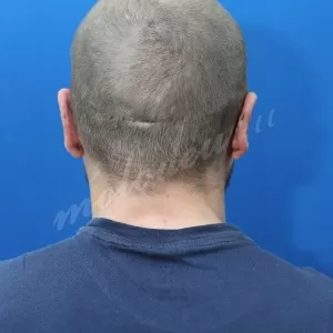 Отопластика_Агаев