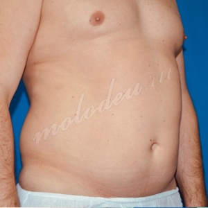 Липомоделирование Мирзарахимов