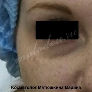 Носослезные борозды Матюшкина