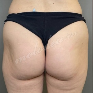 Агаев_липофилинг ягодиц