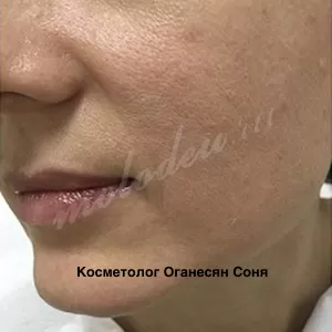 Убрать носогубные складки