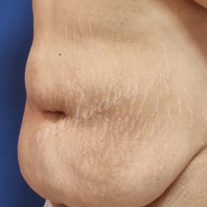 Абдомино_Колбасин