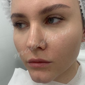 Увеличение губ