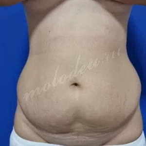 Липосакция живота Агаев