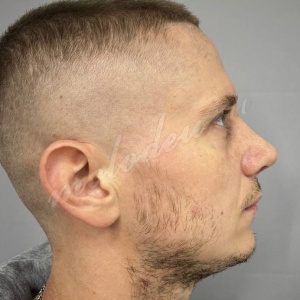 Пирмагомедов_риносепто