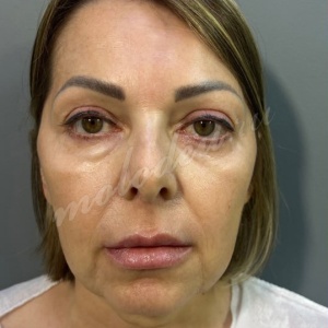 Гусев_подтяжка смас