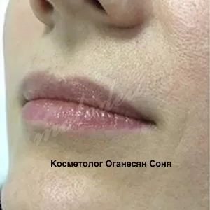 Увеличение губ — Оганесян