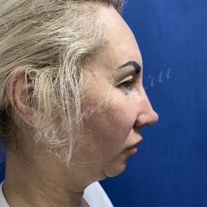 Мирзабекян_ментопластика_блефаро_липо_подбородка_2021