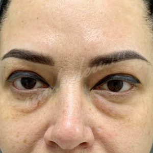 Блефаропластика_Каракаева