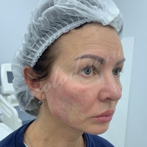 Биоармирование Радиесс