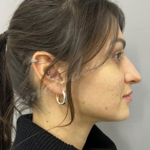 Липосакция подбородка_Мирзарахимов