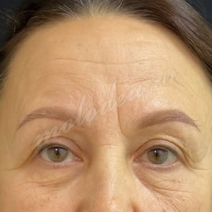 Гусев_лобно-височн_блефаро